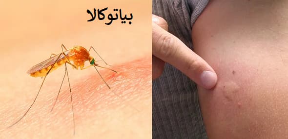 زخم پشه